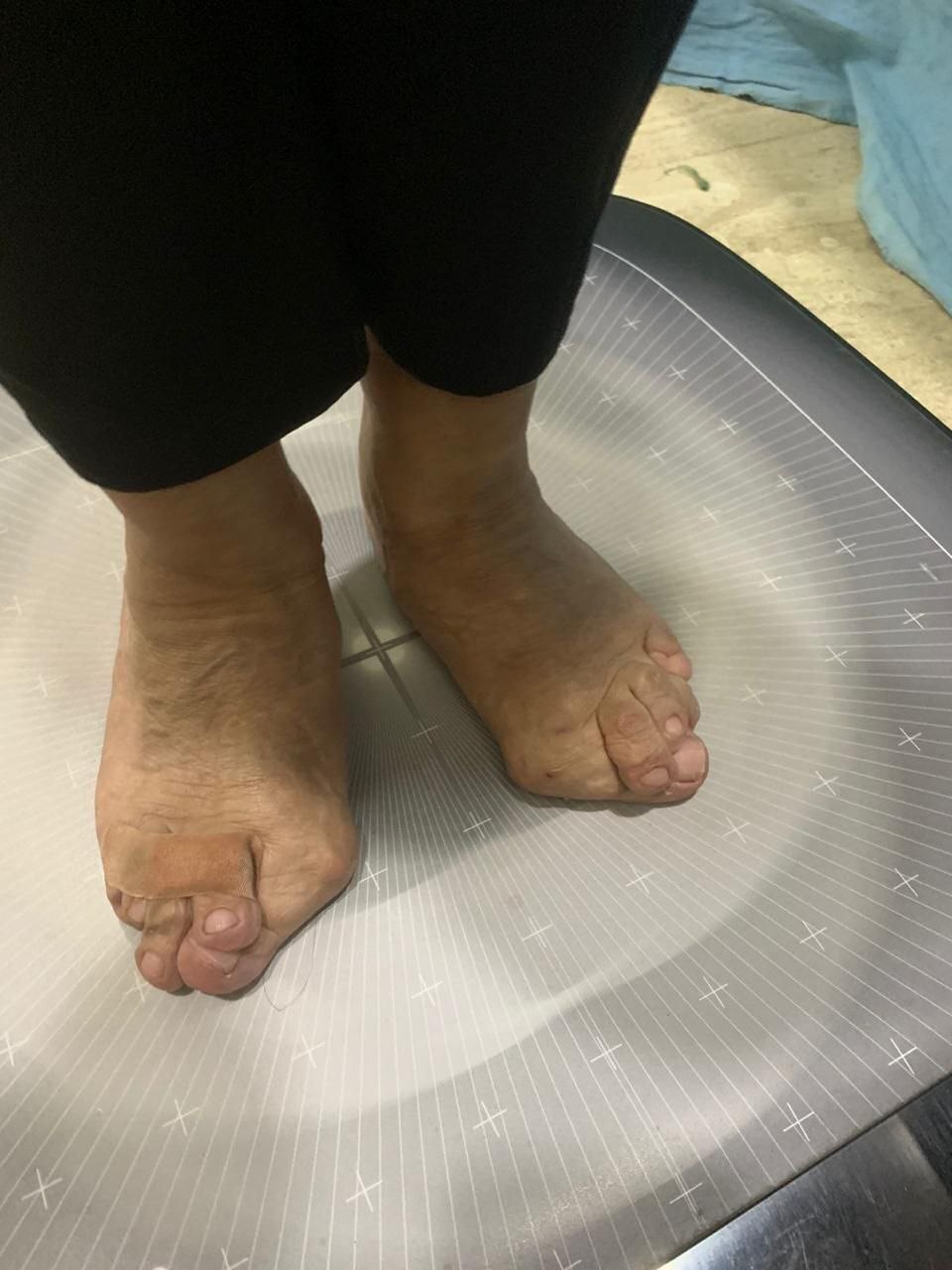 B/L Toe Bunion